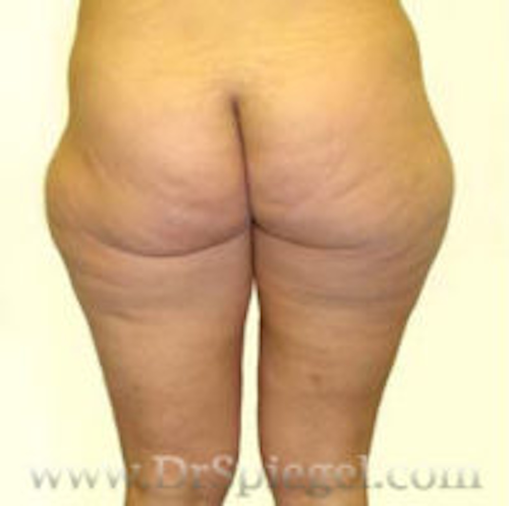 Liposuction