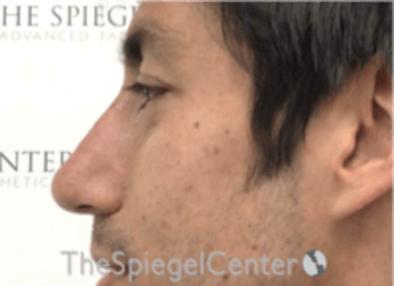 Non-Surgical Rhinoplasty / Nose Filler Before & After Gallery - Patient 157140720 - Image 4