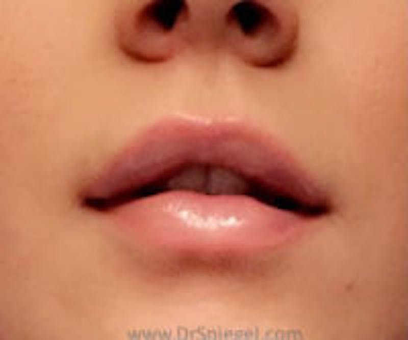 Lip Filler Before & After Gallery - Patient 157140726 - Image 2