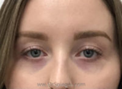 Tear Trough / Under Eye Fillers Before & After Gallery - Patient 157140727 - Image 1