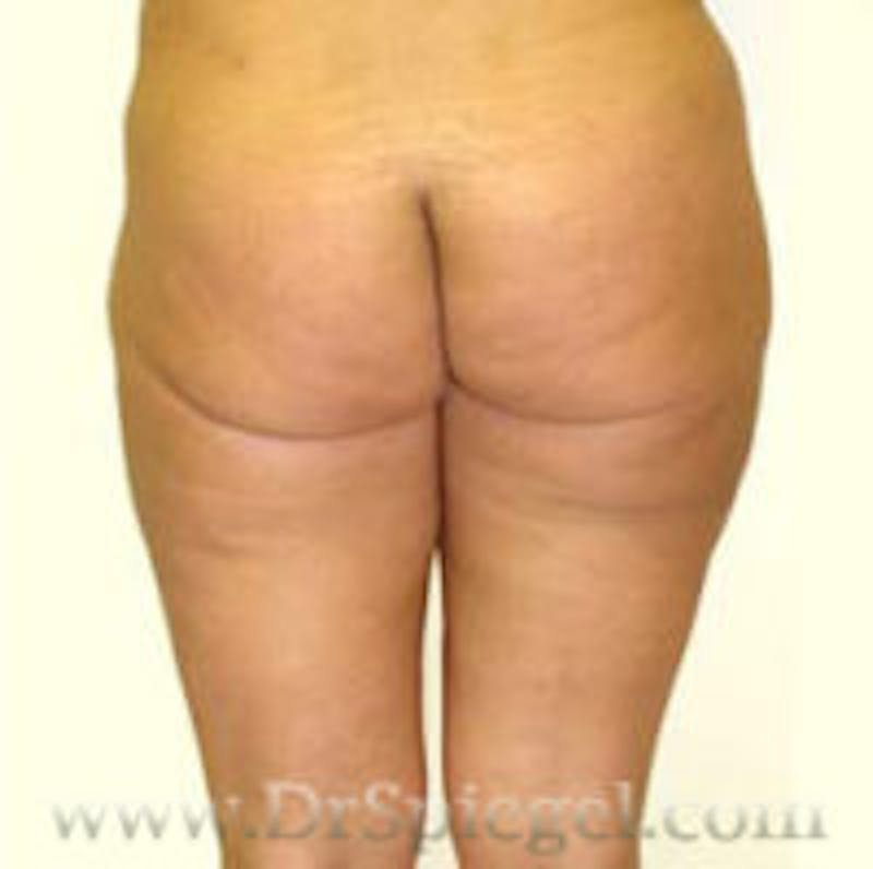 Liposuction Before & After Gallery - Patient 157140722 - Image 2