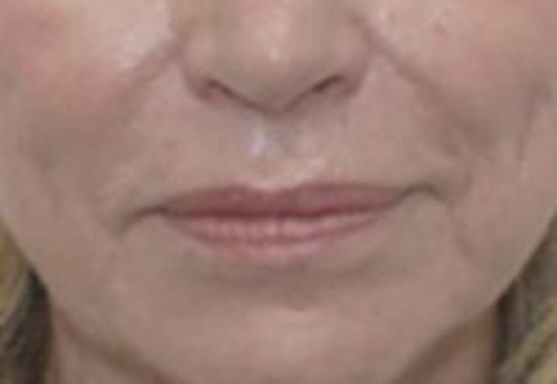 Nasolabial Fold Filler Before & After Gallery - Patient 157140724 - Image 1