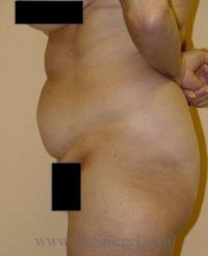 Tummy Tuck Before & After Gallery - Patient 157140729 - Image 1
