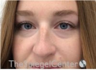 Non-Surgical Rhinoplasty / Nose Filler Before & After Gallery - Patient 157140732 - Image 1