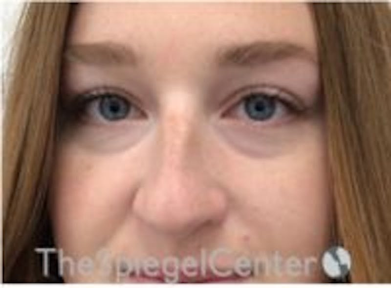 Non-Surgical Rhinoplasty / Nose Filler Before & After Gallery - Patient 157140732 - Image 1