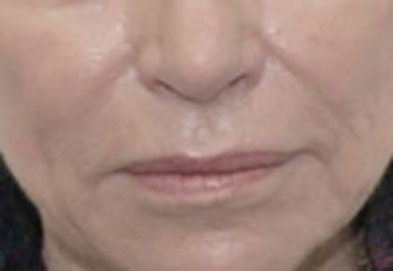 Nasolabial Fold Filler Before & After Gallery - Patient 157140724 - Image 2