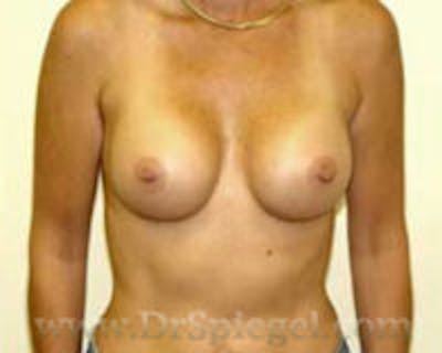 Breast Augmentation Before & After Gallery - Patient 157140730 - Image 2
