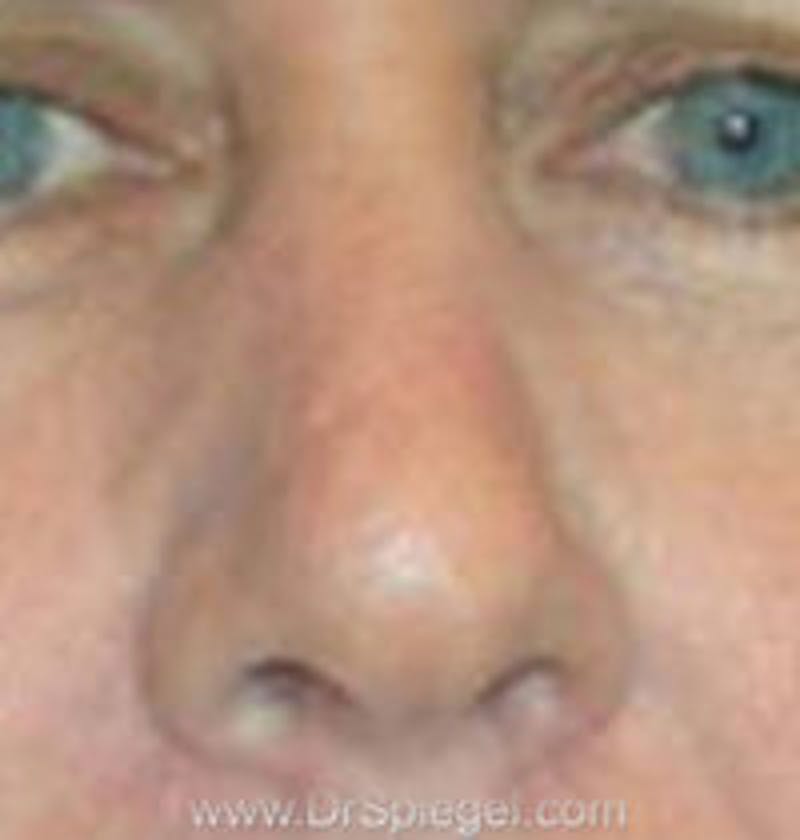 Rhinoplasty Before & After Gallery - Patient 157140734 - Image 1