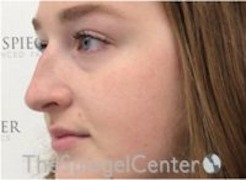 Non-Surgical Rhinoplasty / Nose Filler Before & After Gallery - Patient 157140732 - Image 3