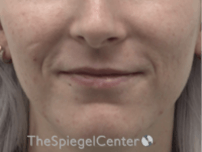 Lip Filler Before & After Gallery - Patient 157140742 - Image 1