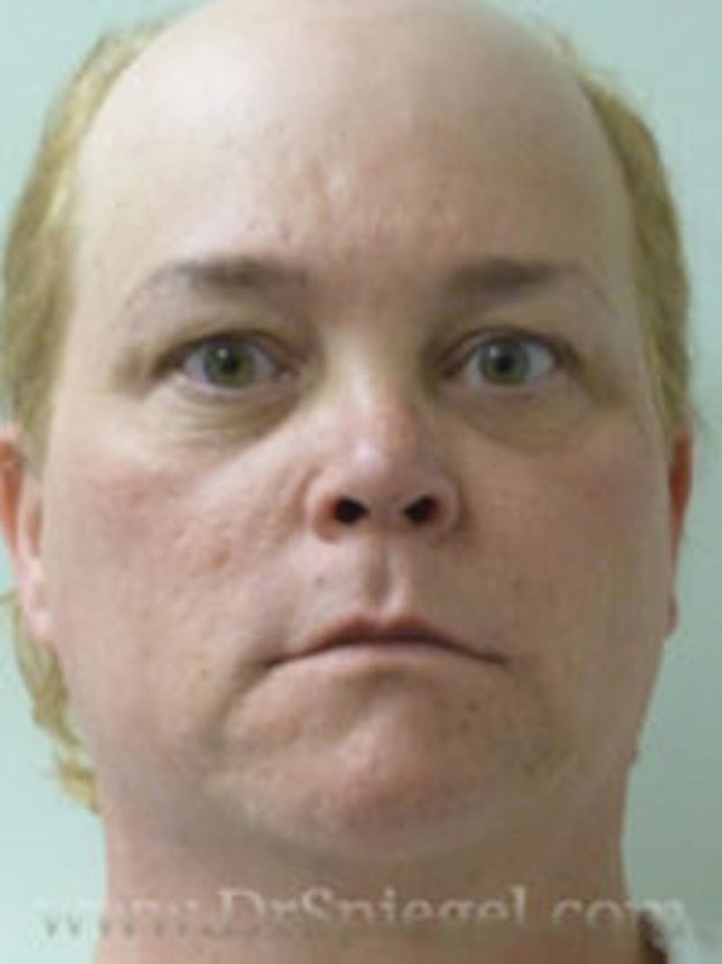 FFS Before & After Gallery - Patient 157140735 - Image 1