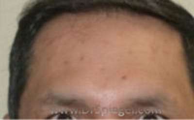 Scar Revision Before & After Gallery - Patient 157140733 - Image 2