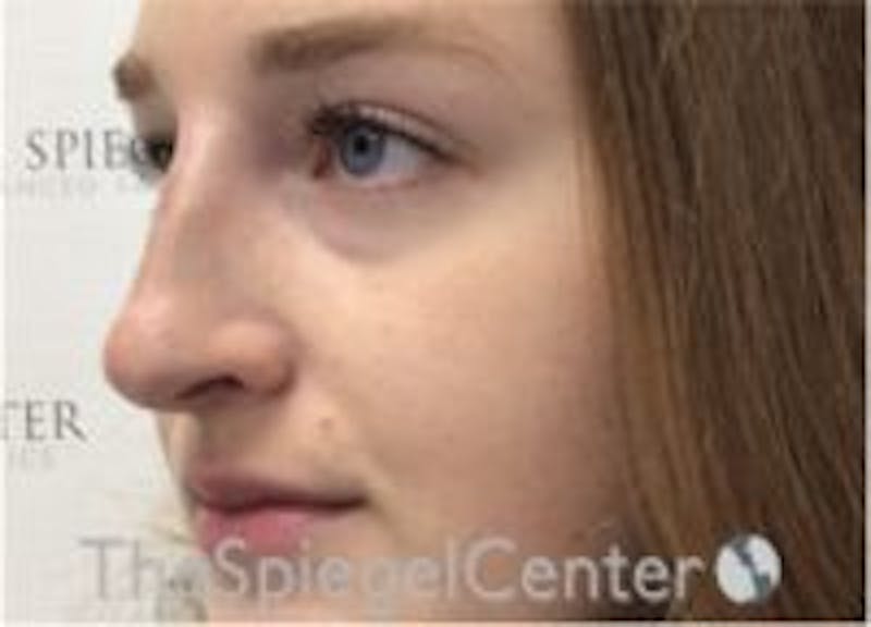 Non-Surgical Rhinoplasty / Nose Filler Before & After Gallery - Patient 157140732 - Image 4