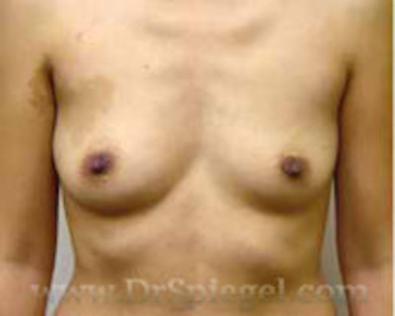 Breast Augmentation Before & After Gallery - Patient 157140737 - Image 1
