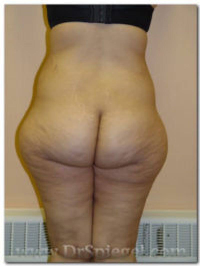Liposuction Before & After Gallery - Patient 157140738 - Image 1