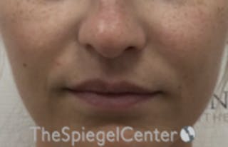 Nasolabial Fold Filler Before & After Gallery - Patient 157140740 - Image 2
