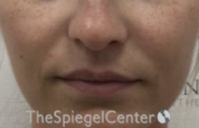 Nasolabial Fold Filler Before & After Gallery - Patient 157140740 - Image 2