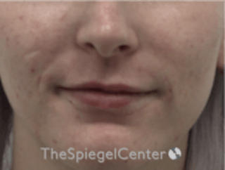 Lip Filler Before & After Gallery - Patient 157140742 - Image 2