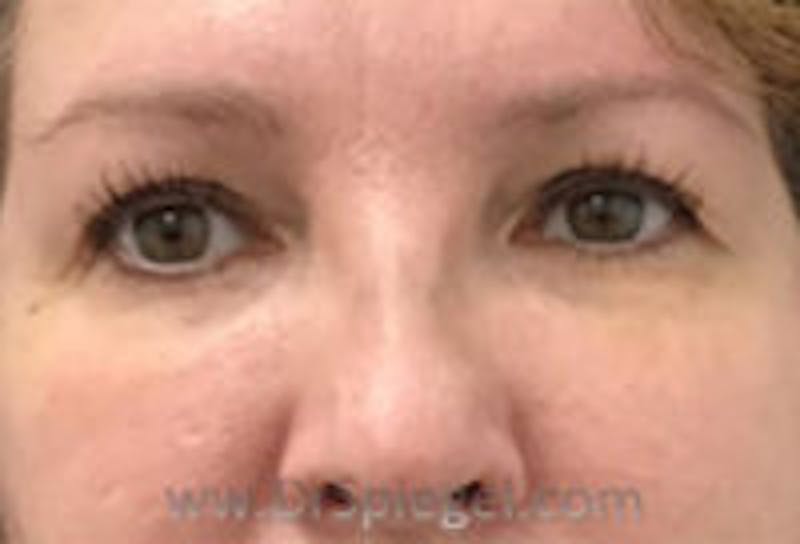 Tear Trough / Under Eye Fillers Before & After Gallery - Patient 157140741 - Image 2