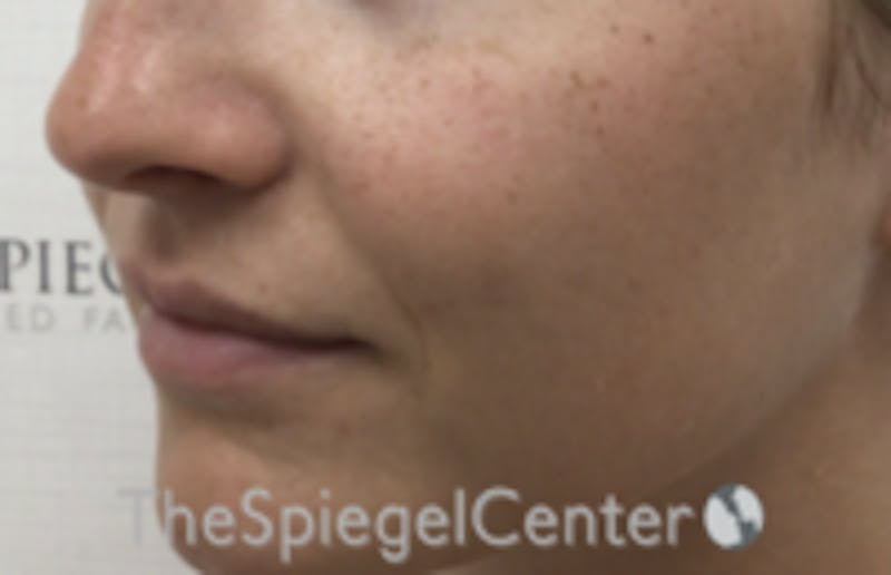 Nasolabial Fold Filler Before & After Gallery - Patient 157140740 - Image 3