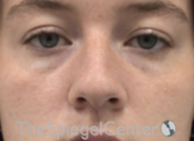 Non-Surgical Rhinoplasty / Nose Filler Before & After Gallery - Patient 157140745 - Image 1