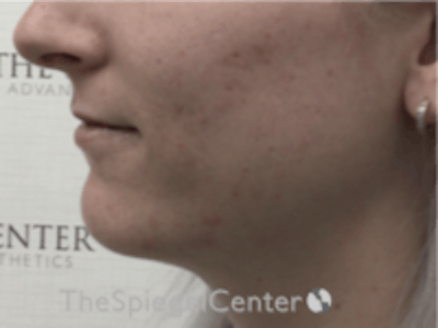 Lip Filler Before & After Gallery - Patient 157140742 - Image 3