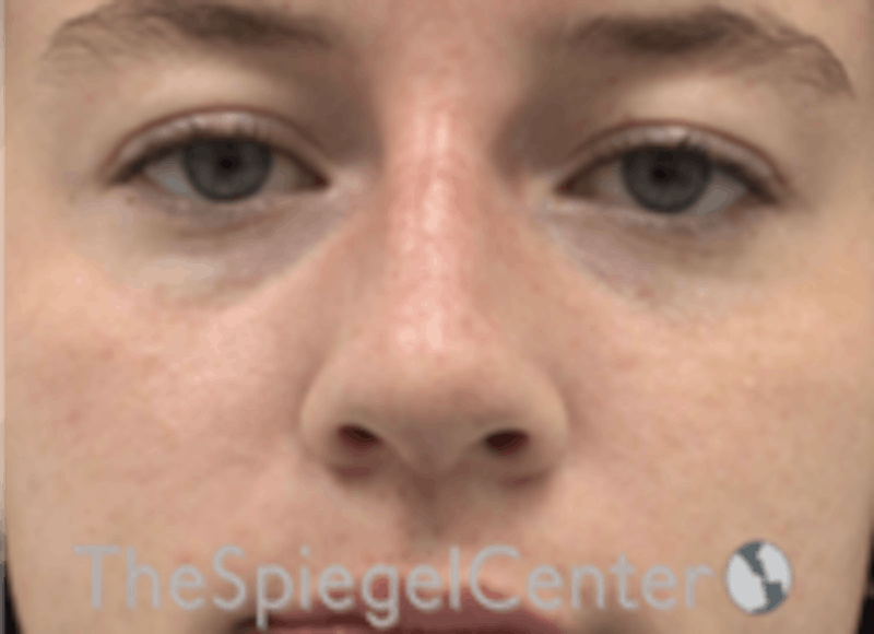 Non-Surgical Rhinoplasty / Nose Filler Before & After Gallery - Patient 157140745 - Image 2