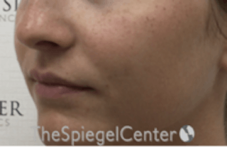 Nasolabial Fold Filler Before & After Gallery - Patient 157140740 - Image 4