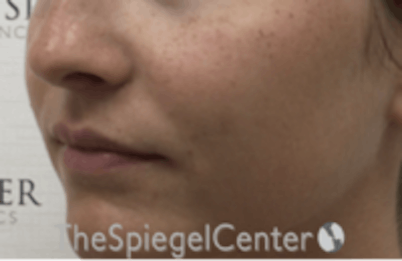 Nasolabial Fold Filler Before & After Gallery - Patient 157140740 - Image 4