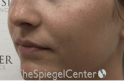 Nasolabial Fold Filler Before & After Gallery - Patient 157140740 - Image 4