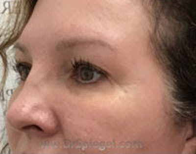 Tear Trough / Under Eye Fillers Before & After Gallery - Patient 157140741 - Image 4