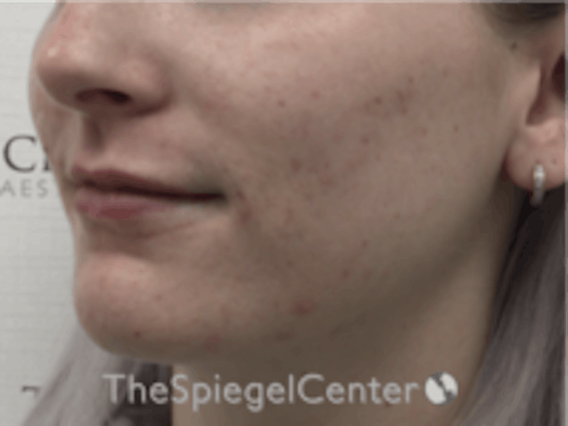 Lip Filler Before & After Gallery - Patient 157140742 - Image 4