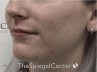 Lip Filler Before & After Gallery - Patient 157140742 - Image 4