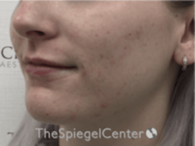 Lip Filler Before & After Gallery - Patient 157140742 - Image 4