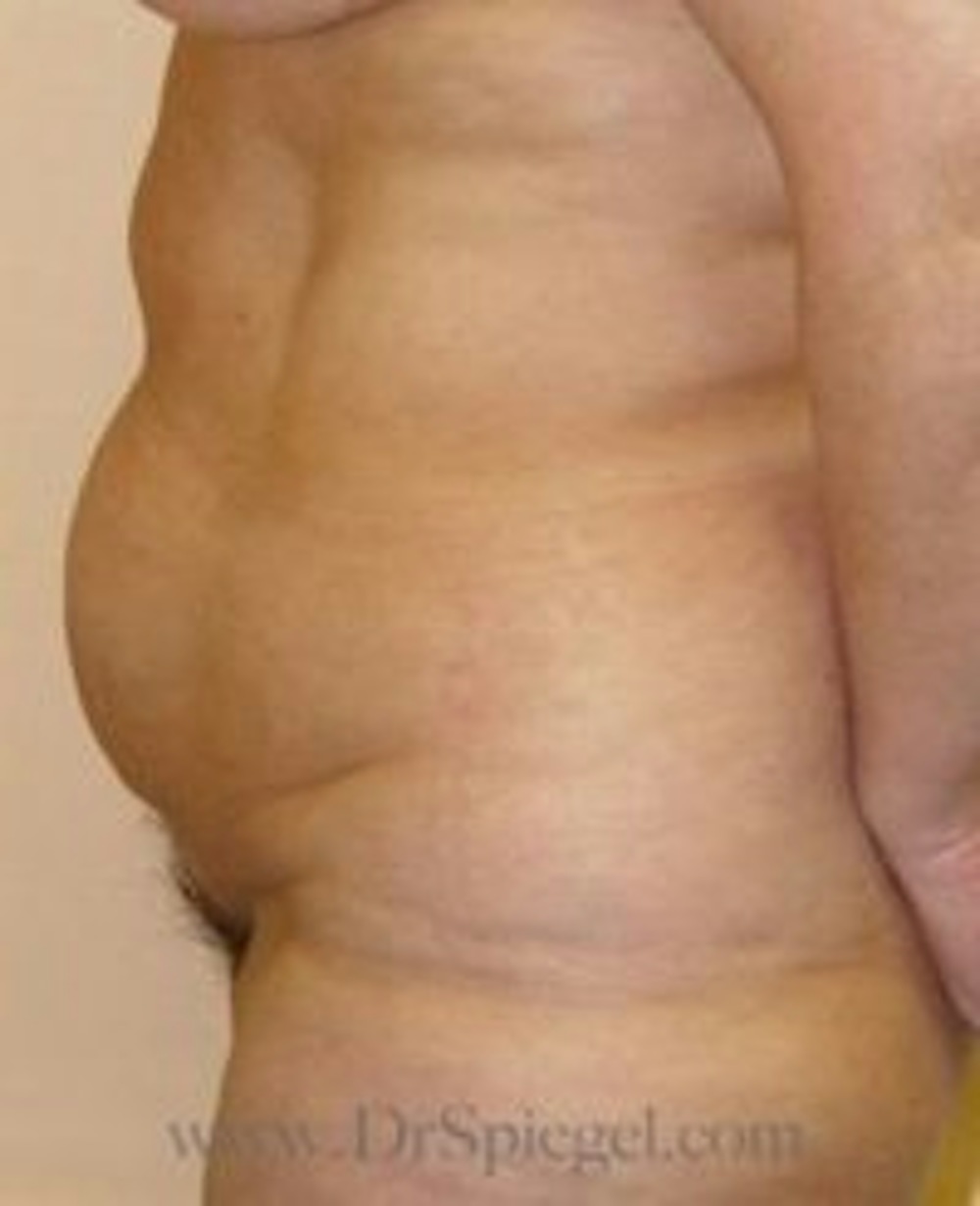 Tummy Tuck