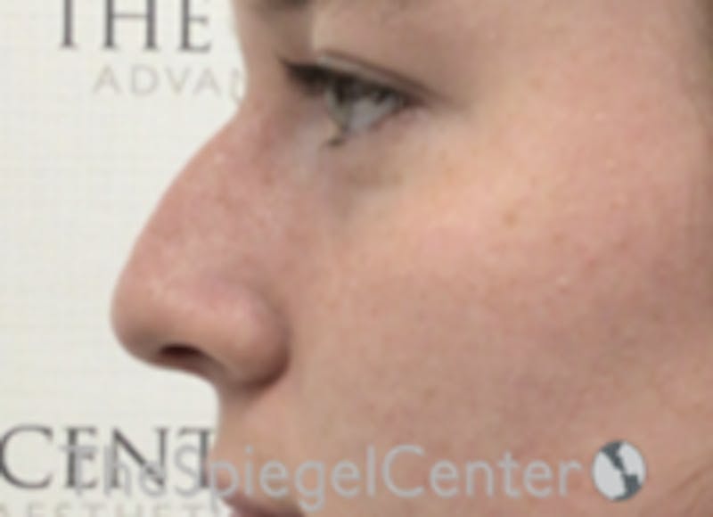 Non-Surgical Rhinoplasty / Nose Filler Before & After Gallery - Patient 157140745 - Image 3
