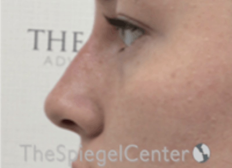 Non-Surgical Rhinoplasty / Nose Filler Before & After Gallery - Patient 157140745 - Image 4