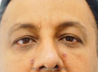 Tear Trough / Under Eye Fillers Before & After Gallery - Patient 157140751 - Image 2