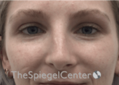 Non-Surgical Rhinoplasty / Nose Filler Before & After Gallery - Patient 157140755 - Image 1