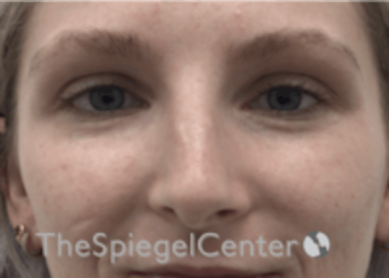 Non-Surgical Rhinoplasty / Nose Filler Before & After Gallery - Patient 157140755 - Image 1