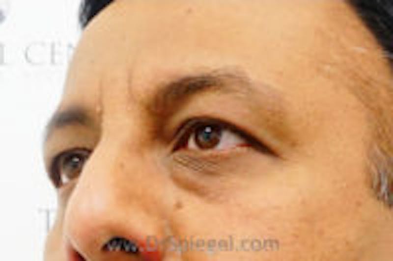 Tear Trough / Under Eye Fillers Before & After Gallery - Patient 157140751 - Image 3