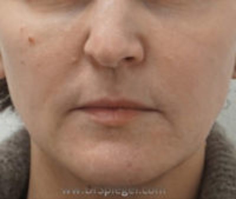 Nasolabial Fold Filler Before & After Gallery - Patient 157140753 - Image 1