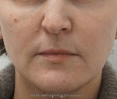 Nasolabial Fold Filler Before & After Gallery - Patient 157140753 - Image 1