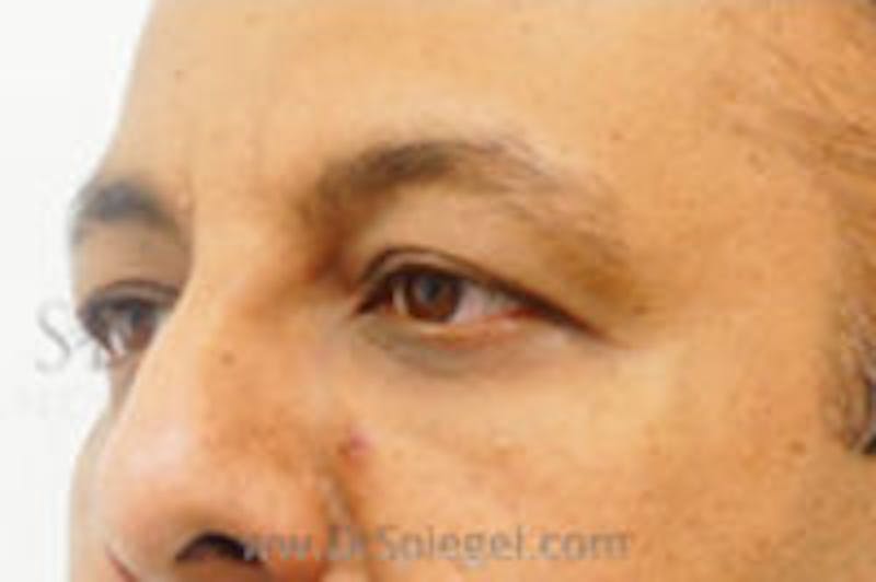 Tear Trough / Under Eye Fillers Before & After Gallery - Patient 157140751 - Image 4