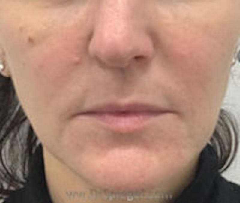 Nasolabial Fold Filler Before & After Gallery - Patient 157140753 - Image 2