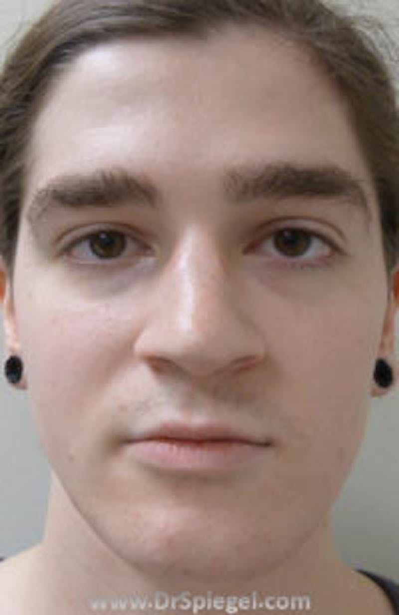 FFS Before & After Gallery - Patient 157140756 - Image 1
