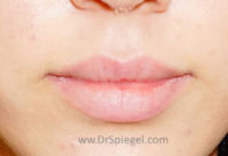 Lip Filler Before & After Gallery - Patient 157140759 - Image 1