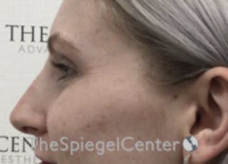 Non-Surgical Rhinoplasty / Nose Filler Before & After Gallery - Patient 157140755 - Image 4