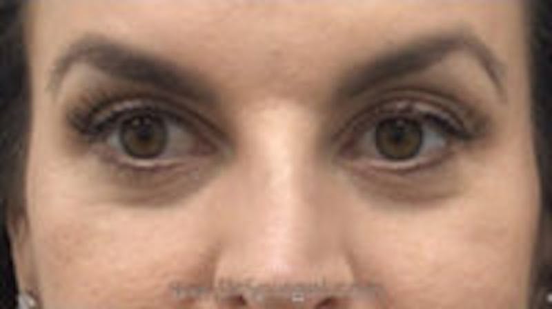 Tear Trough / Under Eye Fillers Before & After Gallery - Patient 157140760 - Image 1