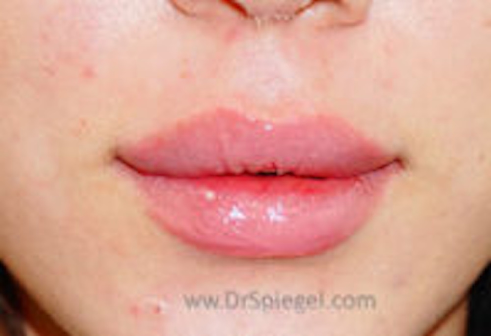 Lip Filler